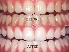 Natural Teeth Whitening Remedies, Teeth Whitening Remedies, Teeth Whitening Diy, Teeth Whitening Toothpaste, Teeth Whitening Gel, Tooth Sensitivity, Best Teeth Whitening, Natural Teeth Whitening, Teeth Whitening Kit