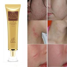 RtopR Acne Scar Stretch Marks Bleach Cream Sửa da mặt Kem trị mụn Mụn trứng cá Điều trị mụn đầu trắng Kem làm trắng da Chăm sóc da mặt tự rám nắng & Làm mờ da từ Làm đẹp & Sức khỏe trên AliExpress | Tập đoàn Alibaba Acne Mark Removal, Acne Scar Cream, Acne Scar Removal Cream, Scar Removal Cream, Face Pores, Scar Cream, Skin Burns, Stretch Mark Cream, Acne Scar