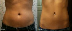 before and after photos of a woman's tummy injection to her stomach, showing the results