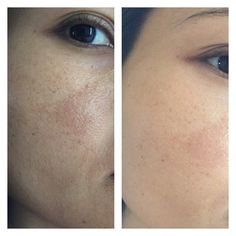 Micronidelling Face, Acne Photos, Skin Shaving, Bb Glow, Cleaning Your Ears, Pimples Overnight, Skin Care Business, Natural Acne Remedies, How To Get Rid Of Pimples