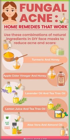 Home Remedy for Treating Fungal Acne. | #Skincaresolutions Back Acne Remedies, Cystic Acne Remedies, Blind Pimple, Fungal Acne, Acne Overnight, Acne Vulgaris, Diy Acne, Natural Acne Remedies, Natural Acne