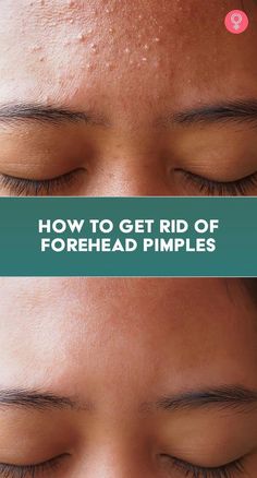 Forehead acne is a condition that affects many men and women worldwide. Learn about its causes, treatment options, and how to prevent it from coming back. Forehead Pimples, Forehead Bumps, Pimples On Forehead, Blind Pimple, Forehead Acne, Pimples Under The Skin, Bad Acne, Pimples Overnight, Acne Overnight