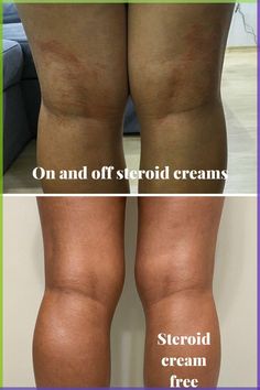 Control Your Eczema Without Steroid Creams With These 5 Easy Steps skincare | beauty | fight concerns | free advice | product reviews Dry Skin Routine, Get Clear Skin, Dry Skin On Face, Better Body, Skin Dryness, Free Advice, Healthy Skin Tips, Skin Remedies