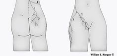 thoracolumbar junction syndrome or magine's syndrome Neuroplasticity Exercises, Hip Anatomy, Hip Flexor Pain, Bursitis Hip, Hip Problems, Lower Back Pain Exercises