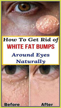 How To Clear Dark Spots Bumps Under Eyes, Medicine Book, Wellness Inspiration, Skin Care Treatments, Health Awareness, Skin Problems, Herbal Medicine, Natural Healing, Beauty Care