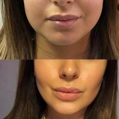 Buccal Fat Removal, Face Slimmer, Glamorous Wedding Makeup, Beauty Treatments Skin Care, Rhinoplasty Surgery, Facial Surgery