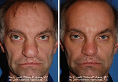 Wide Nasal Bones Before and After Rhinoplasty Patients - Dr Portuese Alternative Treatments, Seattle Washington, Seattle, Bones, Washington