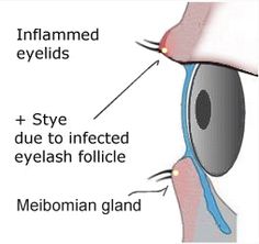 Natural Eye Care: Blepharitis (eyelid inflammation) Vision Loss, Hair And Makeup Tips, Natural Eyes, Eye Care, Allergies, Self Help, Makeup Tips, Eyelashes