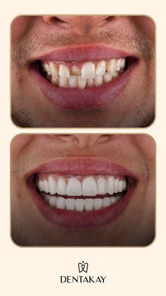 Follow us on Pinterest for more inspiring before and after photos! #zirconia #zirconiumveneers #veneersbeforeafter #crownsbeforeafter #zirconiabeforeafter #beforeafterdentaltreatment Followers Instagram, More Instagram Followers, Grow Instagram, How To Get Followers, Get More Followers, Instagram Engagement, After Photos, Instagram Blog, Instagram Followers