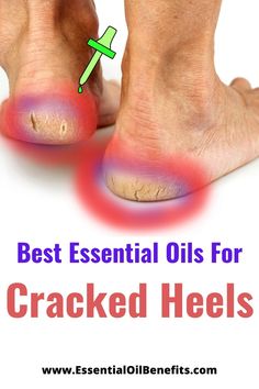 Essential Oils For Cracked Heels: When Achilles Got Nothing On You Healing Cracked Heels, Cracked Heels Remedy Overnight, Cracked Heel Remedy, Healing Strategies, Remedies For Cracked Heels, Feet Soak, Heel Fissures