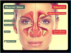 Remedy For Sinus Congestion, Jus Lemon, Blocked Sinuses, Sinus Remedies, Home Remedies For Sinus, Maxillary Sinus, How To Clear Sinuses, Sinus Infection Remedies, Sinus Problems