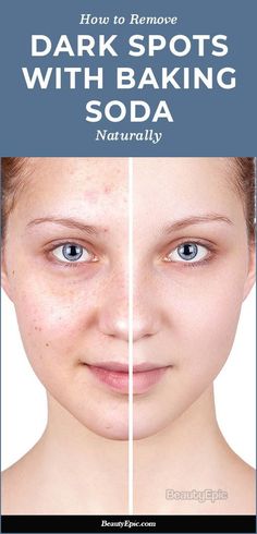 Sunspots On Face, Brown Spots On Hands, Age Spots On Face, Brown Age Spots, Brown Spots On Skin, Baking Soda Benefits, Dark Spots On Face, Brown Spots Removal, Brown Spots On Face