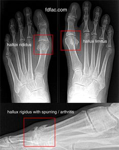 hallux-limitus-rigidus Hallux Limitus Shoes, Hallux Rigidus Shoes, Best Hiking Boots, Bone Diseases, Medical Terms, Cold Remedies, Foot Health, Foot Pain, Walking Boots