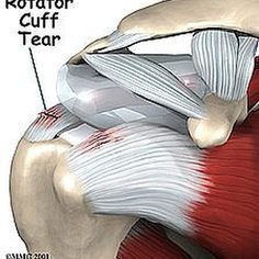 Rotator Cuff Rotator Cuff Rehab, Shoulder Anatomy, Rotator Cuff Surgery, Rotator Cuff Exercises, Psoas Release, Shoulder Rehab, Rotator Cuff Tear, Rotator Cuff Injury, Shoulder Surgery