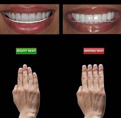 Teeth Makeover, Dental Pictures, Dental Posts, Dental Posters, Dental Aesthetics, Dental Videos, Veneers Teeth, Kedokteran Gigi, Dental Anatomy