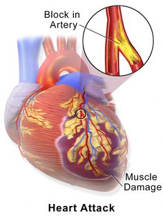 In a surprising new finding, heart attack patients treated with a substantially lower dosage of beta-blockers than used in earlier clinical trials showing their effectiveness survived at the same rate, or even better, than patients on the higher doses used in those trials. Clear Arteries, Beta Blockers, Heart Muscle, Coronary Arteries, Heart Problems, Cardiology, Heart Healthy, Way Of Life, A Heart