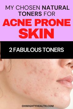 Toning is a very important step in our skincare routine and if you have acne then a natural toner with the right ingredients will help you. Acne can appear for many different reasons but getting used to applying natural skincare is always a good habit to nurture. #acne #tonersforacne #naturaltonersforacne #naturalskincare #greenskincare #ecoskincare Best Toner For Acne, Natural Face Toner, Skincare For Acne, Green Skincare, Natural Toner, Oily Face, Clary Sage Essential Oil, Face Acne