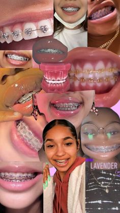 Braces Retainer, Braces And Glasses, Bling Phone Cases Diy