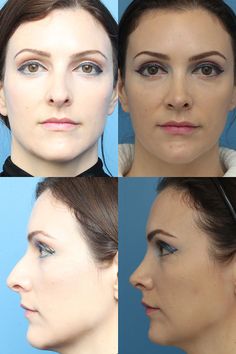 Rhinoplasty Surgery Before and After | Ranch & Coast Plastic Surgery V Line Surgery, Korean Plastic Surgery, Plastic Surgery Gone Wrong, Face Surgery, Rhinoplasty Surgery, Cheek Fillers