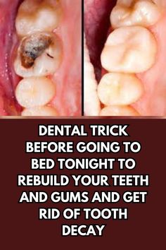 Rebuild Your Teeth and Gums And Get Rid of Tooth Decay! Natural Teeth Whitening Diy, Homemade Toothpaste, Diy Remedies