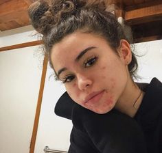 Girl With Acne Aesthetic, Natural Acne, Normal Body, Bare Face, Bare Beauty, Pretty Skin, Raw Beauty