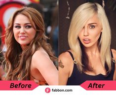 Miley Cyrus Face, Nose Structure, Buccal Fat Removal, Teeth Surgery, Face Transformation, Miley Cyrus Fan, Eyelid Lift, Laser Surgery, Botox Injections