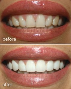 White Teeth Tips, Dental Cover, Perfect Smile Teeth, Teeth Whitening Methods, Tooth Ache Relief, Dental Posts, The Incredible Journey