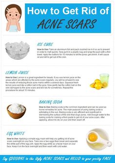 Chest Acne, Skin Care Routine For 20s, Diy Acne, Get Rid Of Acne, Rid Of Acne, Types Of Acne