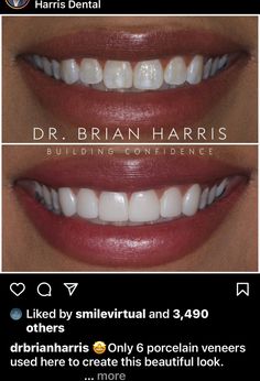 Veneers Teeth Styles, Teeth Goals, Teeth Veneers, Tooth Care, Veneers Teeth, Windows To The Soul, Surgical Procedures, Beautiful Teeth