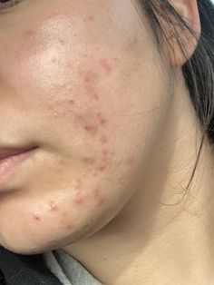 Acne Photos, Acne Pictures, How To Reduce Pimples, Prevent Pimples, Natural Acne, Normal Body, Acne Cream