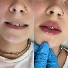 Small Lips Lip Filler, Heavy Upper Lip, Korean Lip Filler, Lip Filler Styles, Lip Injections Before And After, Small Lips Makeup, Keyhole Lips, Russian Lips Filler, Lip Filler Inspiration