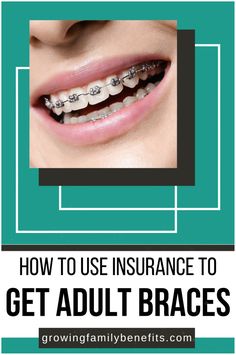 Considering adult braces but worried about insurance delays? Some insurance plans offer immediate coverage, and there are tips to save on orthodontic care. Learn how to explore your options and work toward straight teeth—read the article now!