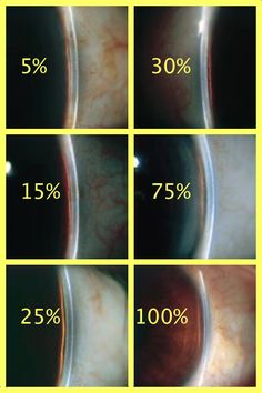 Although not gonioscopy- this is Van Herrick's technique Optometry Education, Eye Medicine, Optical Coherence Tomography, Optometry School, Eye Facts, Eye Anatomy, Laser Eye Surgery, Medical Studies, Eye Exam