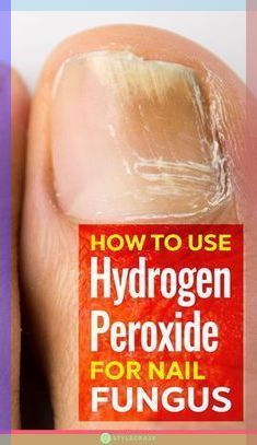 Nail Fungus Remedy, Nail Infection, Fungal Nail, Tongue Health, Ingrown Toe Nail, Toenail Fungus, Fungal Infection, Nail Fungus, Hydrogen Peroxide