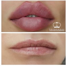 Round Lip Filler Shape, Round Lip Filler, 90s Latina Makeup, Round Lips, Lip Fillers Juvederm, Big Lips Natural, Botox Lips