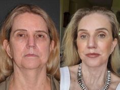 I received this #plasticsurgerybeforeandafter selfie from my 65 years old patient just 3 months after surgery.  She easily looks 20 years younger, but natural and like herself! I love how her surgery just enhanced her beauty but did not change her. I re-balanced her face with multiple procedures to treat drooping of the upper, middle, and lower thirds of her face including her eyelids and lip. I performed a #deepplanefacelift a lateral #temporallift #blepharoplasty #necklift and a #liplift. Deep Plane Facelift, Mini Face Lift, Facelift Surgery, Facelift Before And After, Sagging Cheeks, Facelift Procedure, Sonja Morgan, Face Lift Surgery, Eyelid Lift