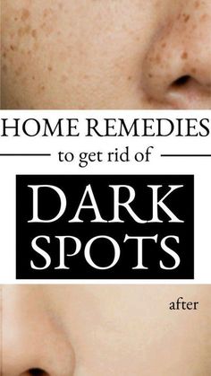 Sun Spots On Skin, Black Spots On Face, Sunspots On Face, Spots On Forehead, Brown Spots On Hands, Brown Age Spots, Brown Spots On Skin, Spots On Legs, Dark Spots On Face