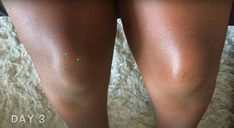 This is a guide to making an all-natural dark knees remedy. Learn about natural ways to lighten dark knees and elbows, plus home remedies for pigmentation, with this easy tutorial. Dark Knees Remedy, Elbow Whitening, Lighten Dark Knees, Dark Knees And Elbows, Sunburn Peeling, Dark Knees, Natural Face Care, Turmeric And Honey, Old Makeup