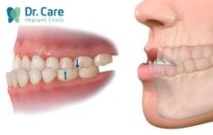 Bị móm răng nên niềng răng bằng mắc cài sứ hay trồng răng Implant?  | Dr. Care Dental Clinic, Quick Saves