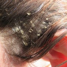 Pimples On Scalp, Hair Diseases, Thick Hair Remedies, Getting Rid Of Dandruff, Hair Dandruff, Skin Photo, Hair Remedies For Growth, Hair Control, Vitamins For Skin