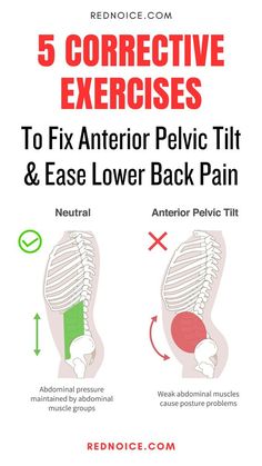 Anterior pelvic tilt is a condition that describes the forward rotation of the pelvis. It affects about 75% of women and 85% of men. When left untreated, this misalignment can lead to health issues, including abnormal lower back curvature, stomach bulge, and hip pain. 🌟 #PelvicTiltAwareness #anteriorpelvictilt Forward Pelvic Tilt, Tilted Pelvis Exercises, Pelvis Exercises, Anterior Pelvic Tilt Correction, Misaligned Pelvis, Misaligned Hips, Fix Anterior Pelvic Tilt, Corrective Exercises, Anterior Pelvic Tilt