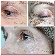 Fibroblast Plasma Skin Tightening, Spa Treatments At Home, Best Dark Spot Remover, Skin Mapping