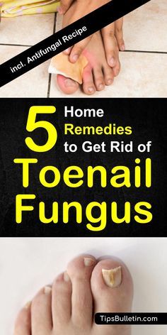 How To Get Rid of Toenail Fungus - 5 Home Remedies includes pictures and tips about remedies to cure toenail fungus fast. Incl. an apple cider vinegar antifungal recipe.#toenailfungus #fungus #remedies Toenail Fungus Remedies, Before After, Essential Oils For Hair, Toenail Fungus, Nail Fungus, Nail Health, Simple Home, Healthy Nails, Pictures Images