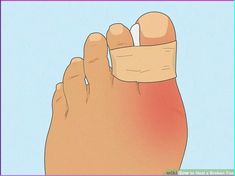 The toes are comprised of small bones (called pha Types Of Fractures, Reduce Bruising, Small Bones, Hairline Fracture, Broken Foot, Diy Wrap, Hiking Backpacking, How To Survive