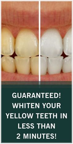 GUARANTEED! WHITEN YOUR YELLOW TEETH IN LESS THAN 2 MINUTES! Homemade Toothpaste, Health Info, Health Advice