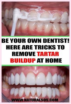 BE YOUR OWN DENTIST! HERE ARE TRICKS TO REMOVE TARTAR BUILDUP AT HOME Teeth Care Routine, Life Tricks, Dental Health Care, Dental Cavities, Teeth Health, Oral Care Routine, Receding Gums, Teeth Care, Oral Health Care