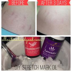 DIY Stretch Mark Remedy - All Natural & Good www.allnaturalandgood.com Diy Stretch Mark Oil, Stretch Mark Oil, Stretch Mark Remedies, Essential Oil Remedy, Young Living Essential Oils Recipes, Dry Skin Remedies, Oil Remedies, Stretch Mark Removal, Yl Essential Oils