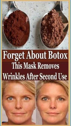 Forget about botox this mask removes wrinkles after second use Face Wrinkle, Anti Aging Homemade, Basic Skin Care, Wrinkle Remedies, Wrinkle Free Skin, Basic Skin Care Routine, Skin Care Wrinkles, Younger Skin, Face Wrinkles