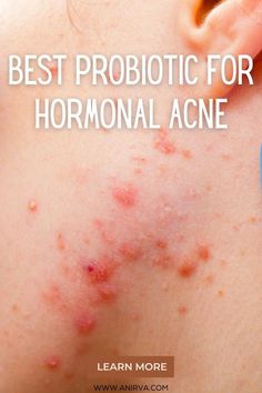 Acne is a skin condition where the hair follicles are blocked with oil (sebum) and dead skin cells. This then leads to a variety of manifestations – from minor blackheads to pus-filled pimples and tender red bumps.  Types of Acne Acne can be ‘triggered’ by a lot of things. Non-hormonal acne, for one, can occur due to g Anti Acne Diet, Comedonal Acne, Hormonal Acne Remedies, Acne Help, Best Probiotic, Acne Skincare Routine, Extra Dry Skin