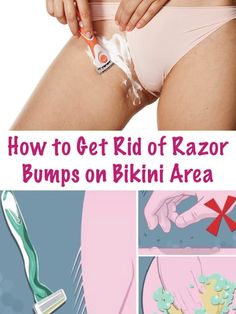 Shaving can cause razor burns, rashes and bumps on your skin, Find here easy treatments for getting rid of razor burn on armpits, legs, face and bikini area. #razorbumps #ingrownhair #bikiniarea Ingrown Hair Armpit, Skin Bumps, Razor Burn, Skin Burns, Razor Bumps, Razor Burns, Moisturizing Body Wash, Unwanted Hair